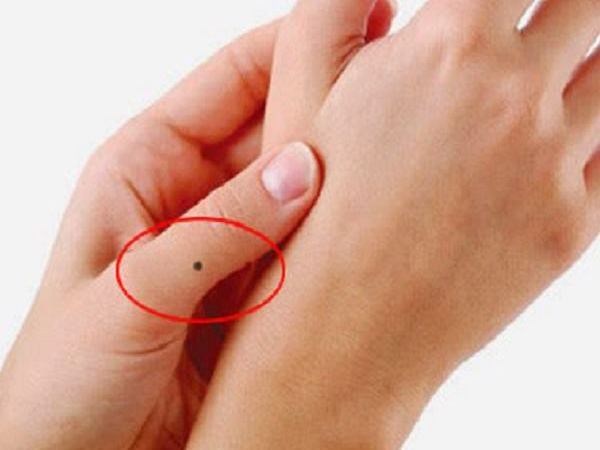 Nốt ruồi trên ngón tay
